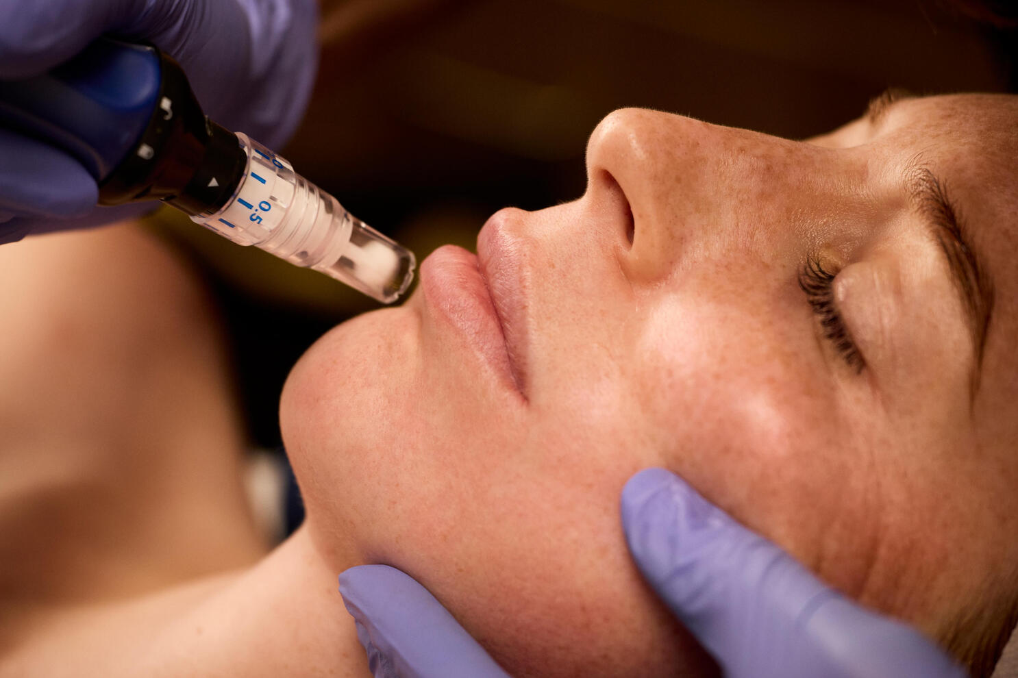 SkinPen Microneedling